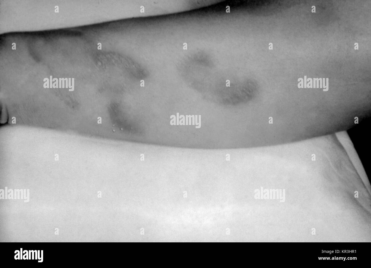A photograph of a patient with tertiary syphilis depicting gummatous lesions on the volar surface of the right arm. Tertiary syphilis occurs many years after initial untreated primary syphilis, 1971. Gummas, or internal tissue granulation, form and result in severe damage to the skin, bone, liver and other bodily organs, or regions. Image courtesy CDC/Susan Lindsley. Stock Photo