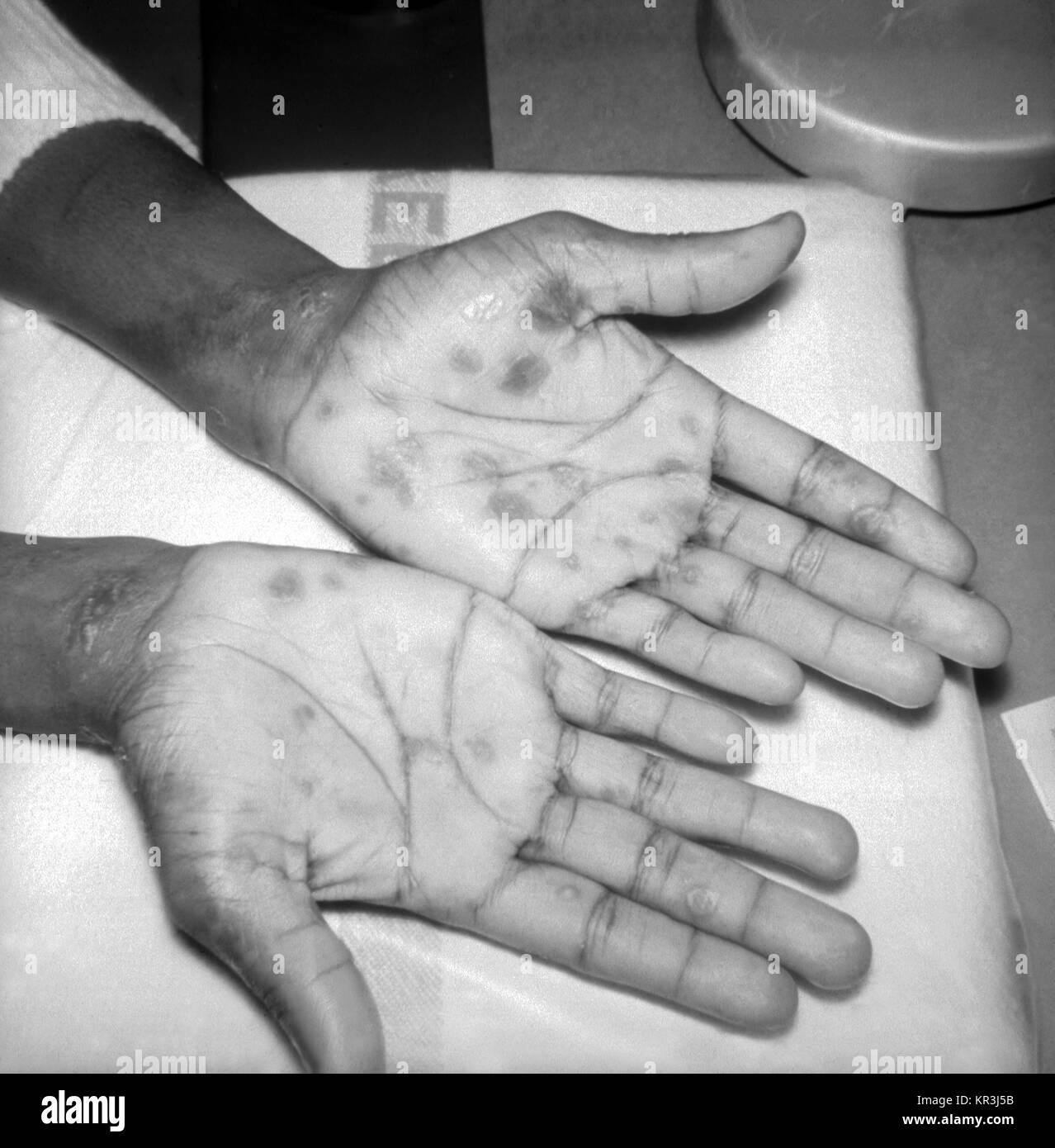 A patient with papulosquamous syphilids, or cutaneous eruptions of the disease, seen here on the wrist and palms. This patient presented with papulosquamous syphilids on the wrist and palms during the secondary stage of syphilis, 1971. The rash often appears as rough, red or reddish brown spots and can appear on both the palms of the hands and on the bottoms of the feet. Image courtesy CDC/Susan Lindsley. Stock Photo