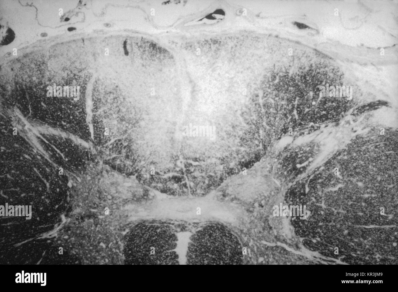 Tabetic neurosyphilis hires stock photography and images Alamy