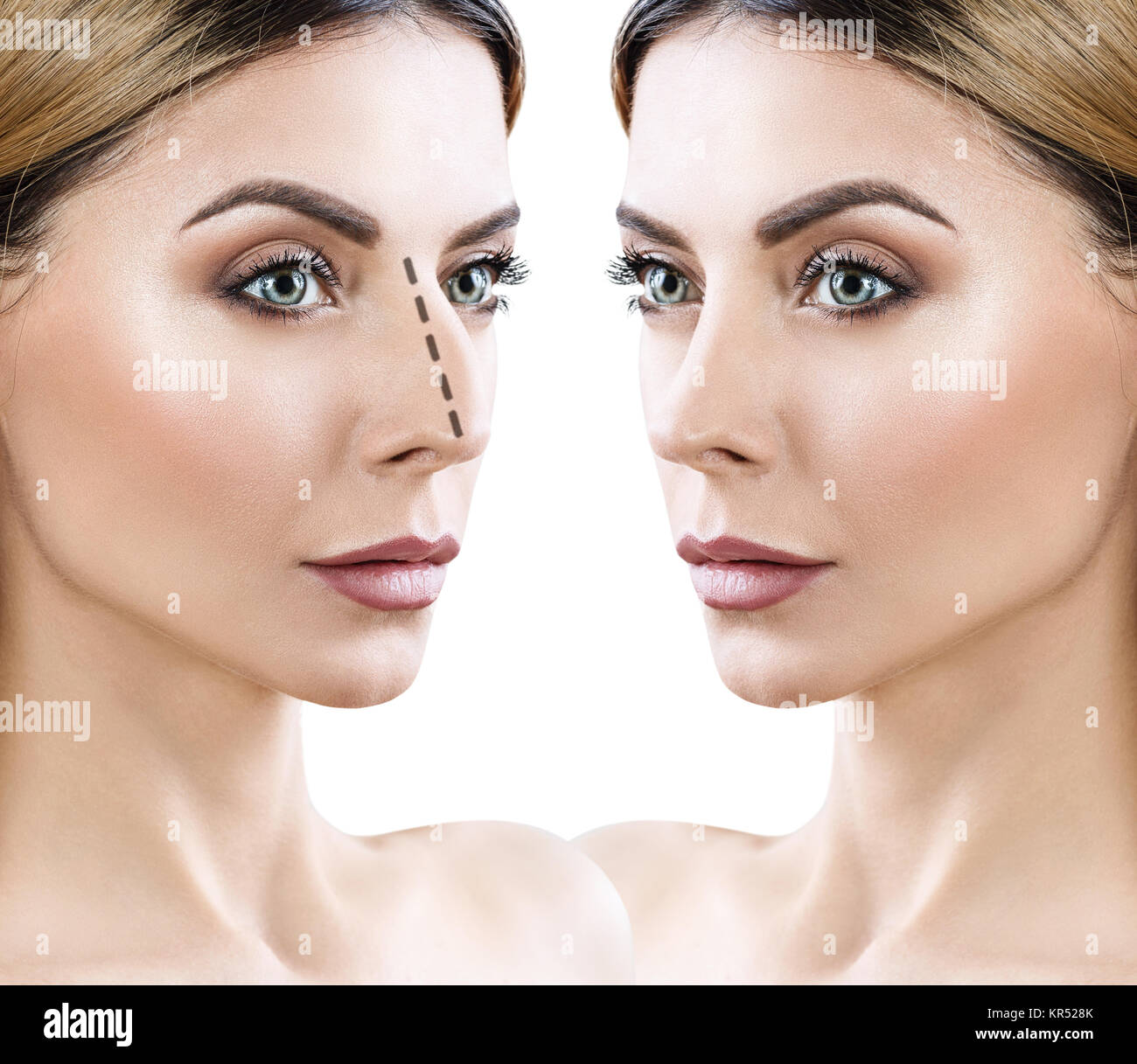 Female nose before and after cosmetic surgery Stock Photo Alamy