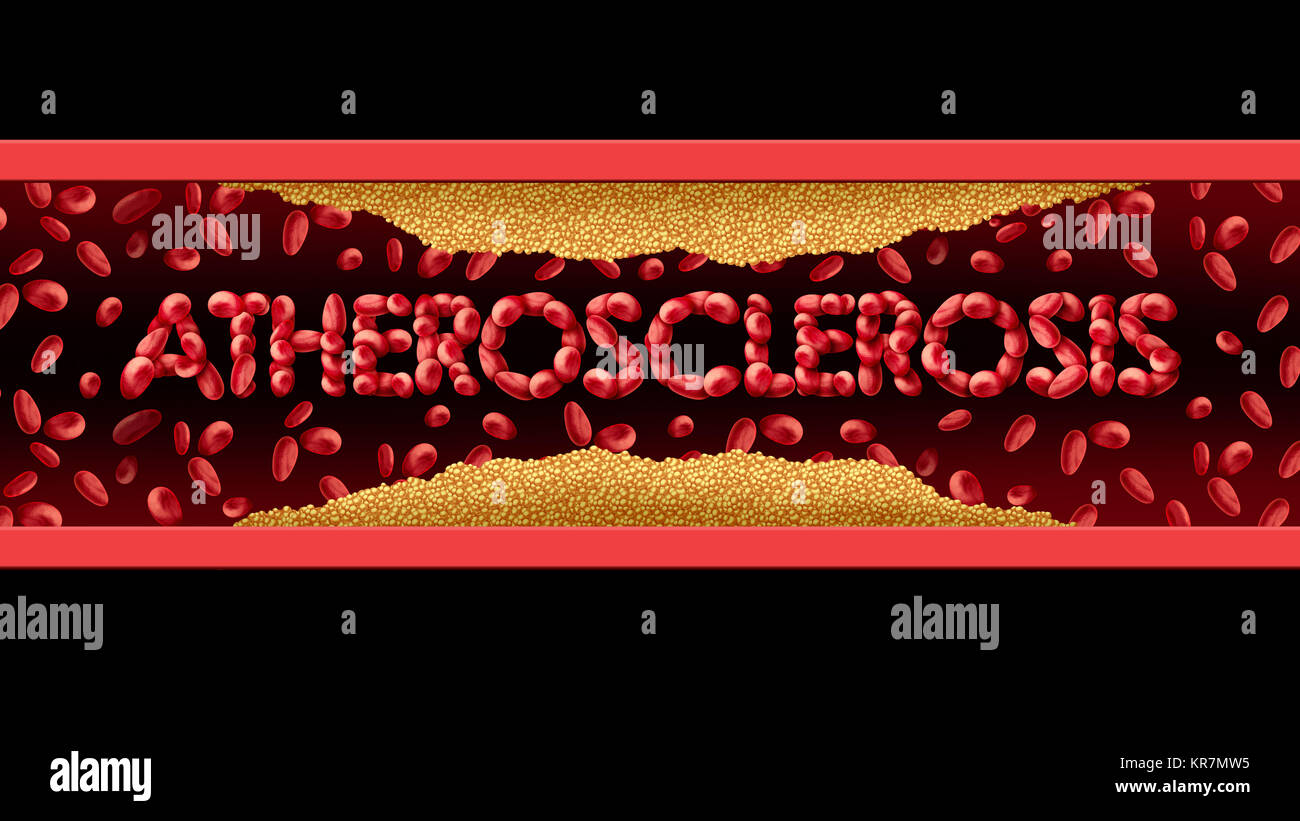 atherosclerosis coronary disease with plaque build up in the arteries