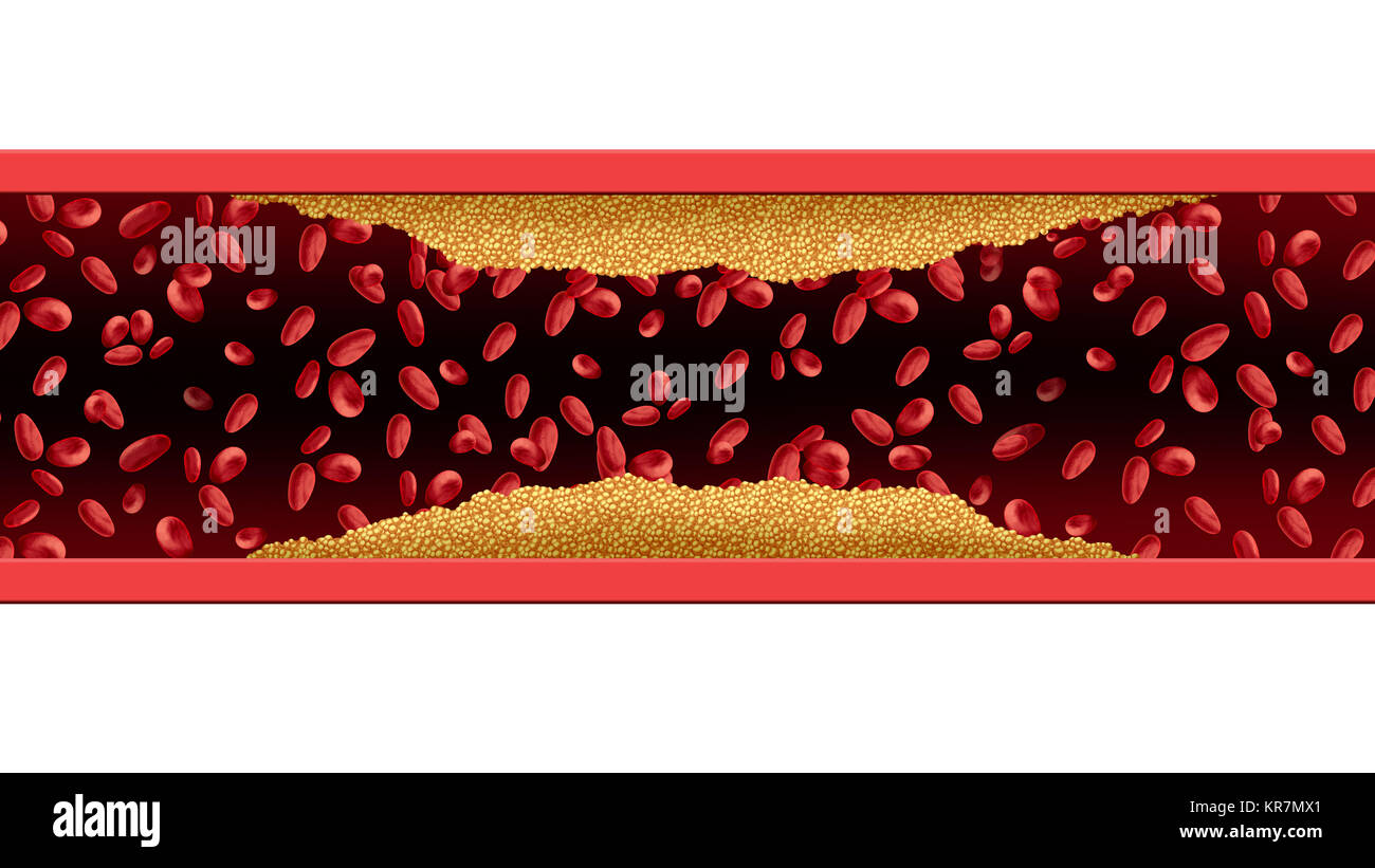 Artery cholesterol risk with blood cells blocked by plaque accumulation ...