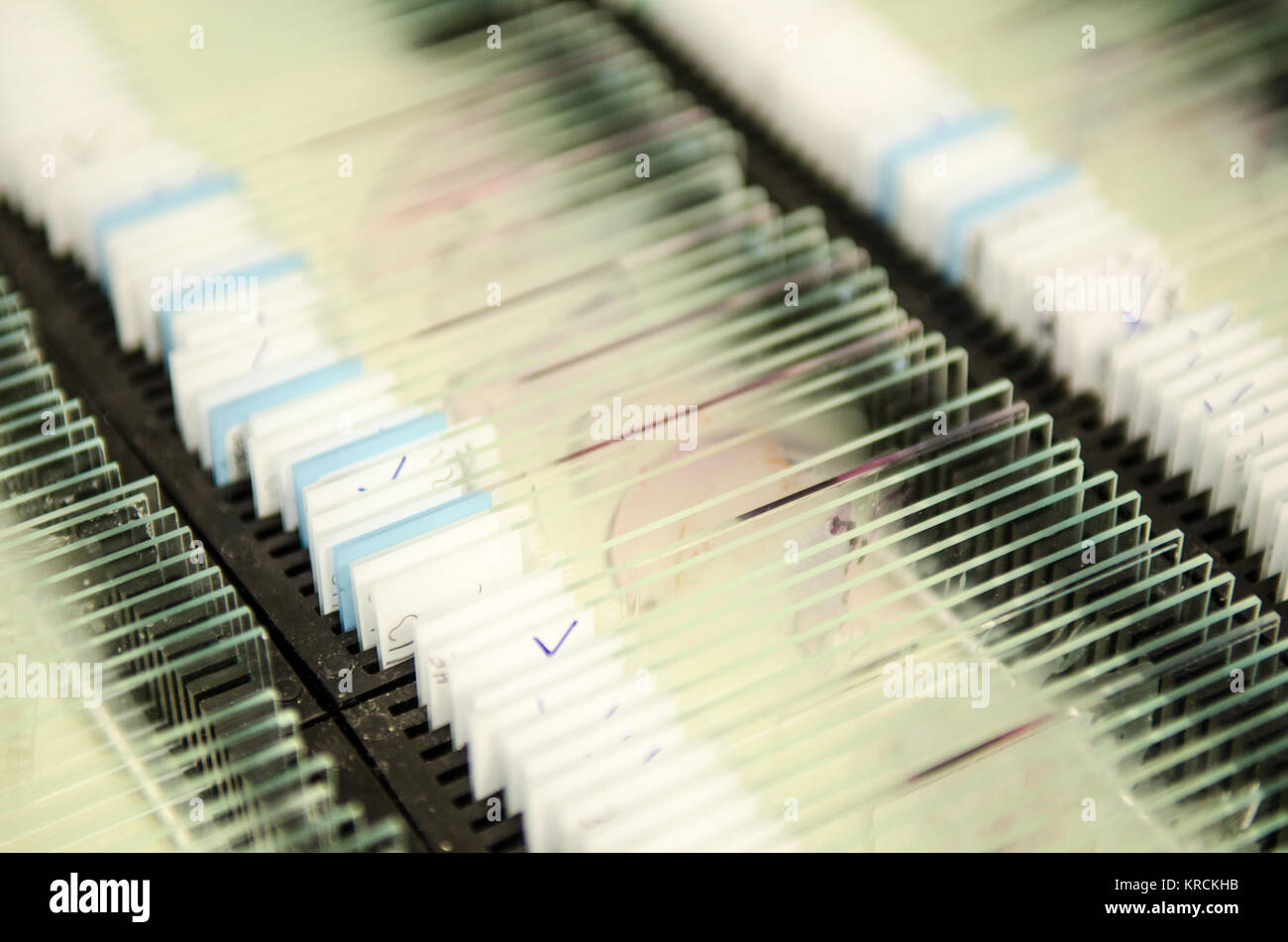 Racks hold large numbers of microscope slides containing patient biopsy test tissue in a diagnostic pathology laboratory. Stock Photo