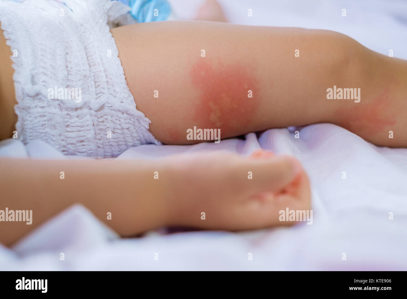 Leg of sleeping Small child with redness on the skin, suffering from food allergies,  Baby's leg covered by eczema. allergy baby skin dermatitis food. Stock Photo
