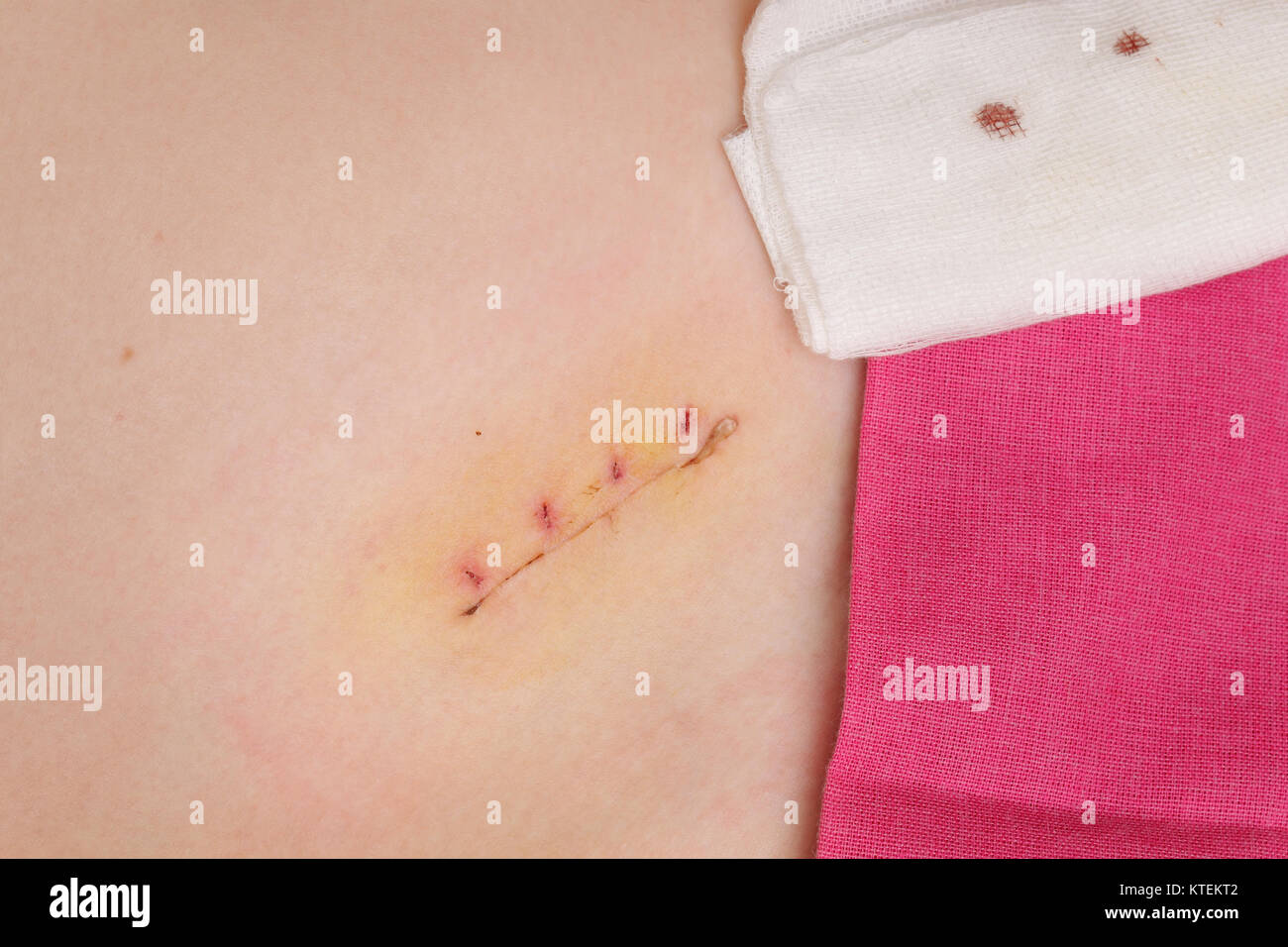 Appendix Scar High Resolution Stock Photography and Images Alamy
