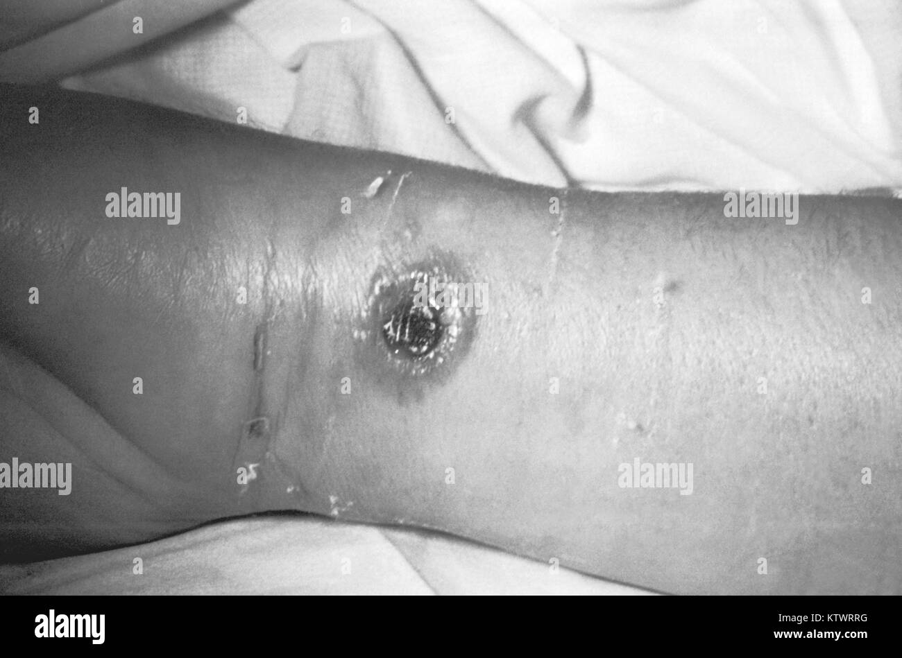 A cutaneous anthrax lesion on the arm of a 50 year old female. This 50 year old female had been a carder in a wool factory for 6 years, 1971. This lesion is on the 8th day of the illness. Cutaneous anthrax usually occurs after skin contact with contaminated meat, wool, hides, or leather from infected animals. Image courtesy CDC/Dr. Philip S. Brachman. Stock Photo