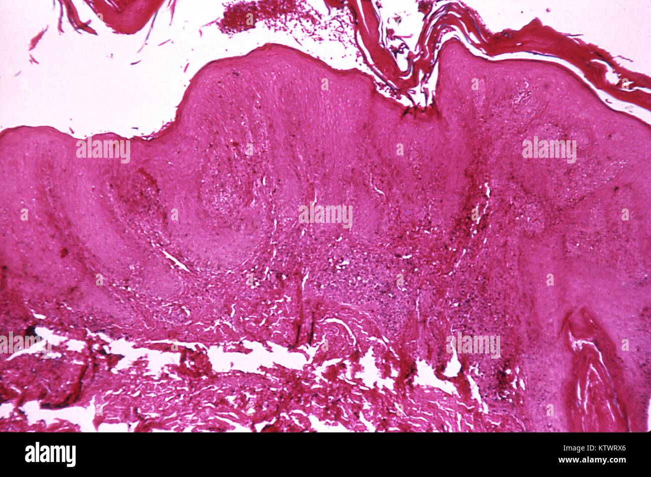 This pinta lesion, stained using the hematoxylin-eosin (HandE) technique, is caused by the bacterium Treponema carateum, magnification 100X. This mature, 20 mos, 1970. old pinta lesion shows signs of hyperkeratosis, parakeratosis, acanthosis, elongation of Rete Pegs and an inflammatory infiltrate in the dermis. The genus Treponema, contains the species pallidum, the cause of syphilis. Image courtesy CDC. Stock Photo