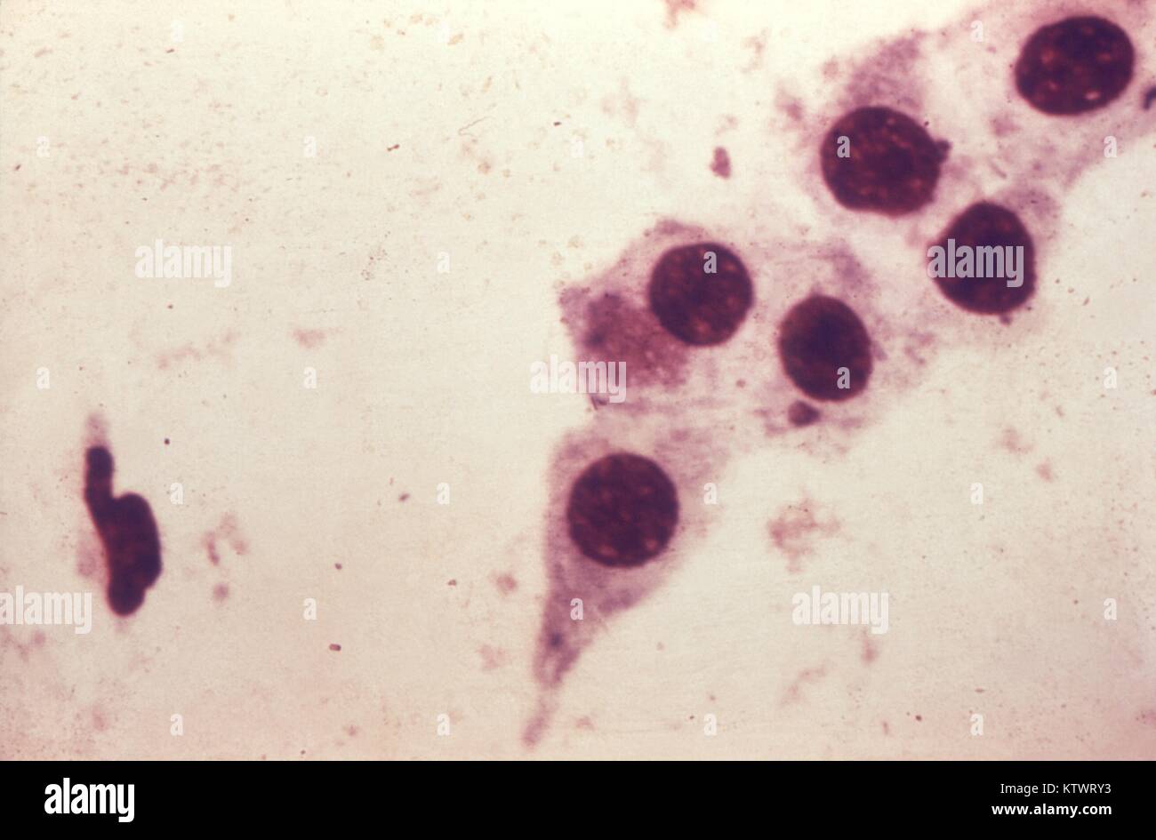 Photomicrograph of Chlamydia trachomatis taken from a urethral scrape. Untreated, chlamydia can cause severe, costly reproductive and other health problems including both short- and long-term consequences, i.e. pelvic inflammatory disease (PID), infertility, and potentially fatal tubal pregnancy, 1973. Image courtesy CDC/Dr. Wiesner, Dr. Kaufman. Stock Photo