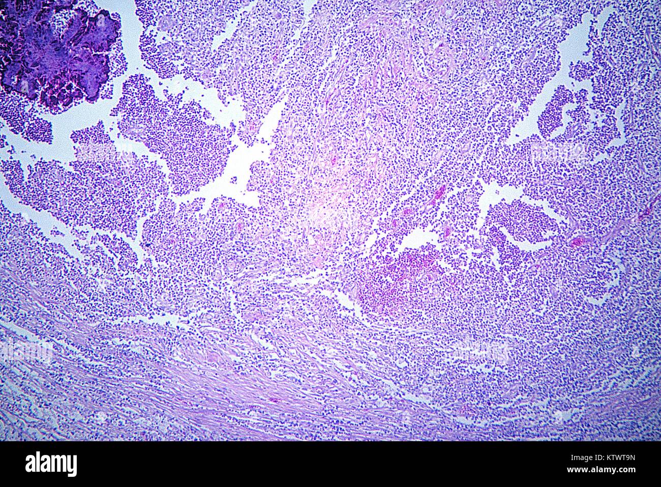 A photomicrograph depicting the histopathology associated with pulmonary actinomycosis. A suppurative disease caused by Gram-positive endogenous oral bacteria of the family Actinomycetaceae . Note the fibrotic, thick-walled abscess formation, and presence of granulation tissue indicative of a chronic inflammatory process. Image courtesy CDC/Dr. Martin Hicklin, 1964. Stock Photo