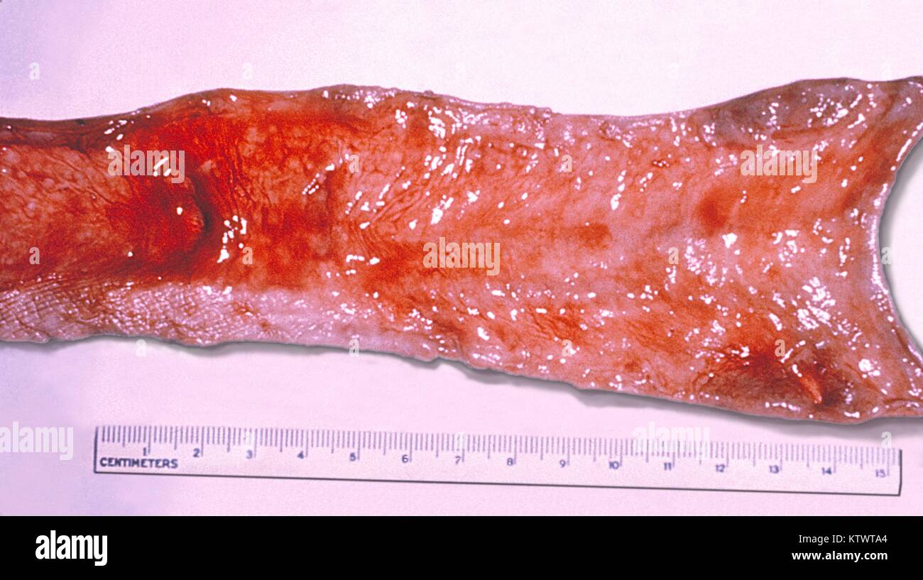 Typhoid fever cholecystitis with an ulceration and perforation of the gallbladder into the jejunum. Salmonella typhi, the bacterium responsible for causing Typhoid Fever, has a preference for the gallbladder, and if present will colonize the surface of gallstones, which is how people become long term carriers of the disease. Image courtesy CDC/Armed Forces Institute of Pathology, Charles N. Farmer, 1964. Stock Photo