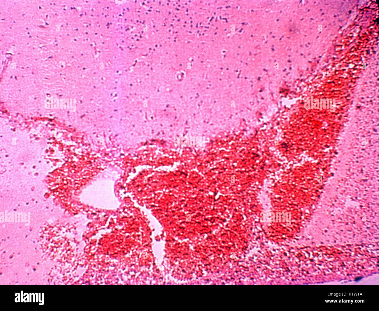 A photomicrograph demonstrating the histopathologic changes in brain tissue due to Salmonella typhi bacteria. Salmonella septicemia has been associated with subsequent infection of virtually every organ system, and the nervous system is no exception. Here we see an acute inflammatory encephalitis due to S. typhi bacteria. Image courtesy CDC/Armed Forces Institute of Pathology, Charles N. Farmer, 1964. Stock Photo