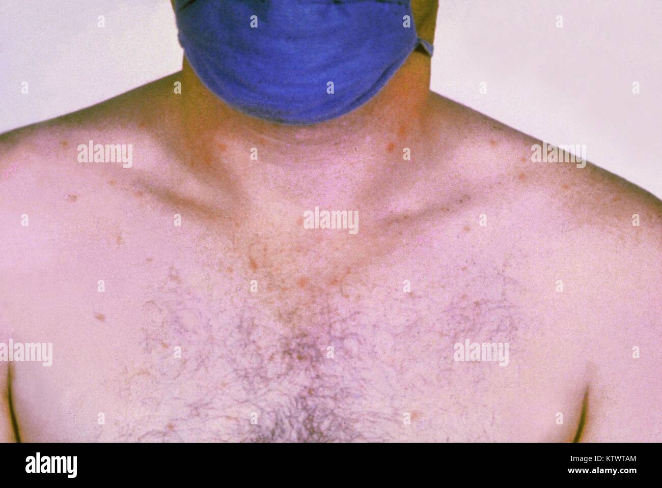 Rose spots on the chest of a patient with typhoid fever due to the