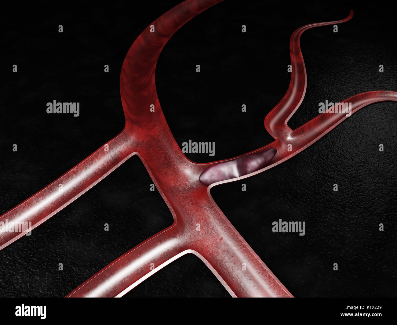 3d illustration of pulmonary thromboembolism. thrombosis of the vessel. Stock Photo