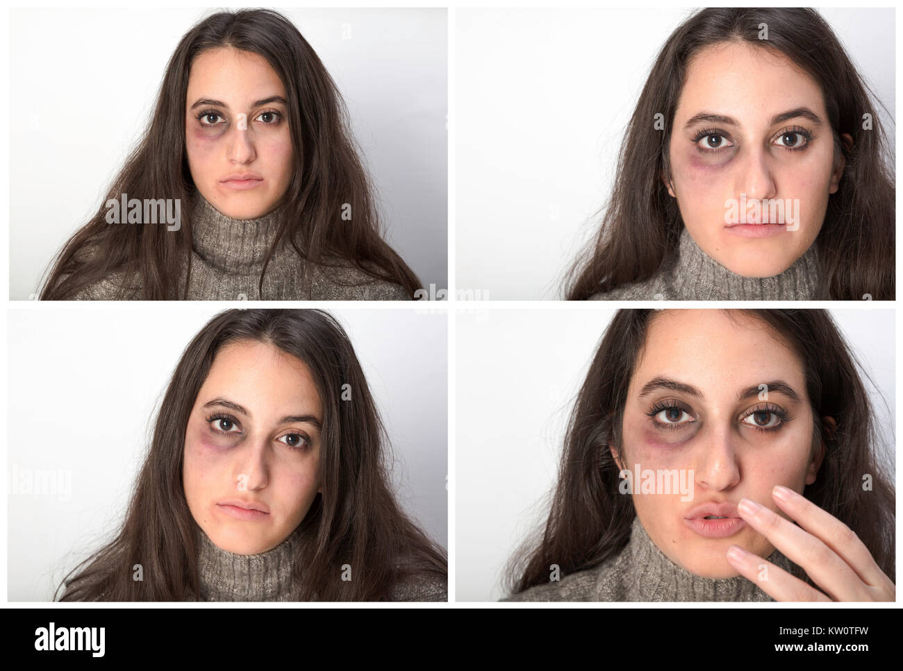 Female bruised eye hires stock photography and images Alamy