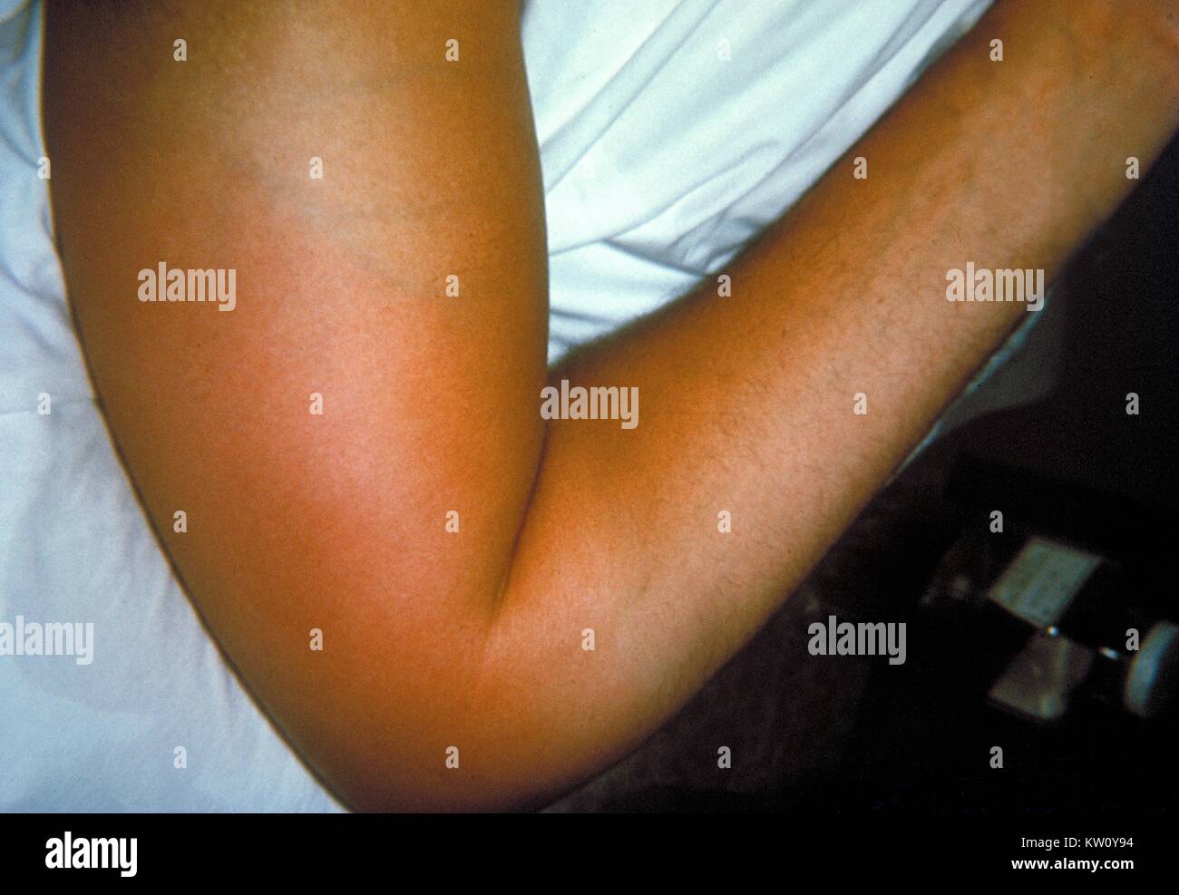Right elbow of a patient with group B Streptococcus (GBS) bacteremia, with localized edema and erythema. Here the GBS bacteria have entered the blood stream and migrated to the subcutaneous tissues of the right elbow causing localized erythema and edema. Image courtesy CDC/Emory University, Dr. Thomas Sellers, 1964. Stock Photo