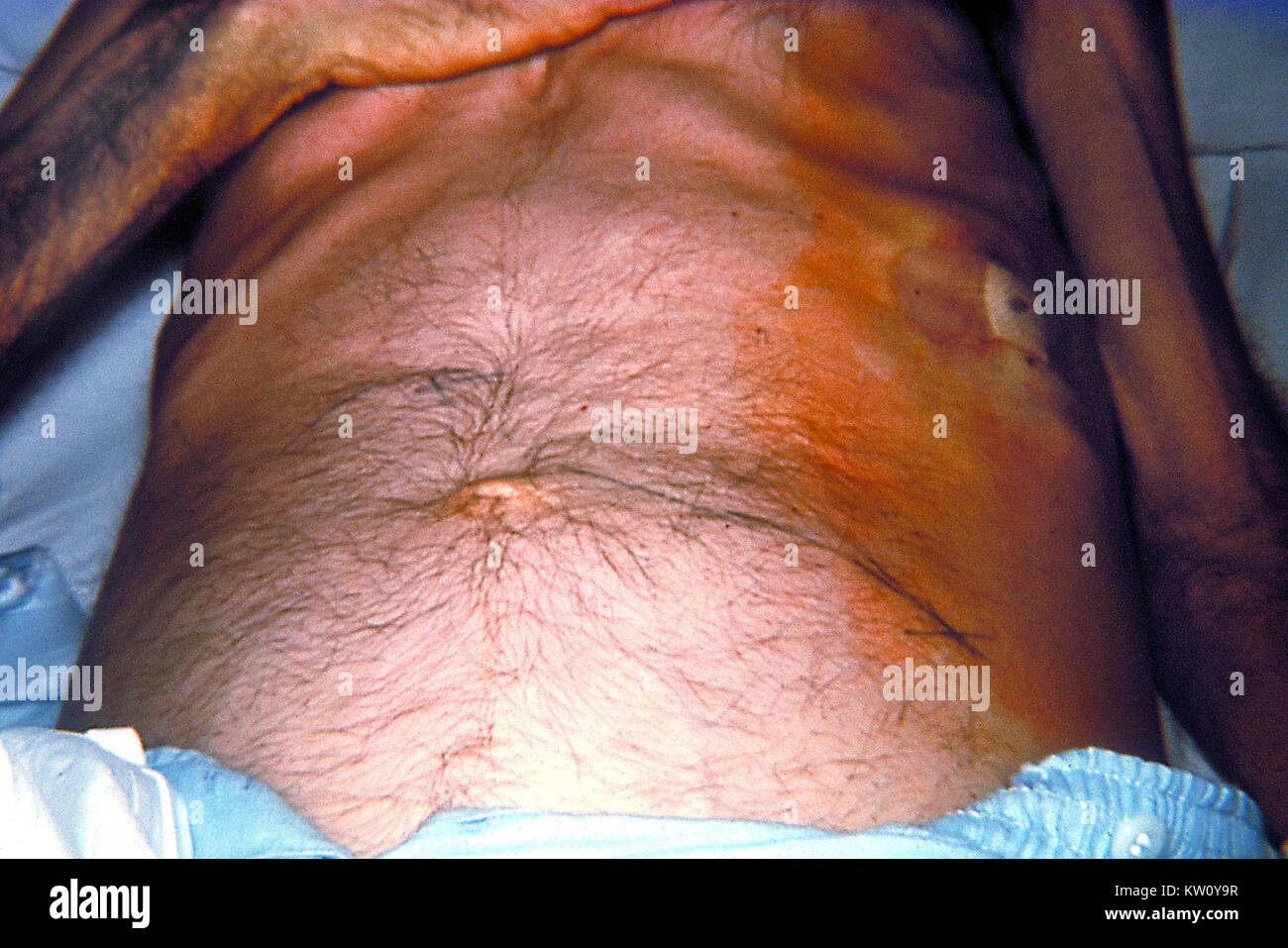An anterior view of a patient with an abdominal carcinoid tumor. These very slow growing tumors usually originate from enterochromaffin cells of the small intestine, and are very rare. One quarter of the time they develop in the lungs. Image courtesy CDC/Emory University, Dr. Thomas Sellers, 1964. Stock Photo