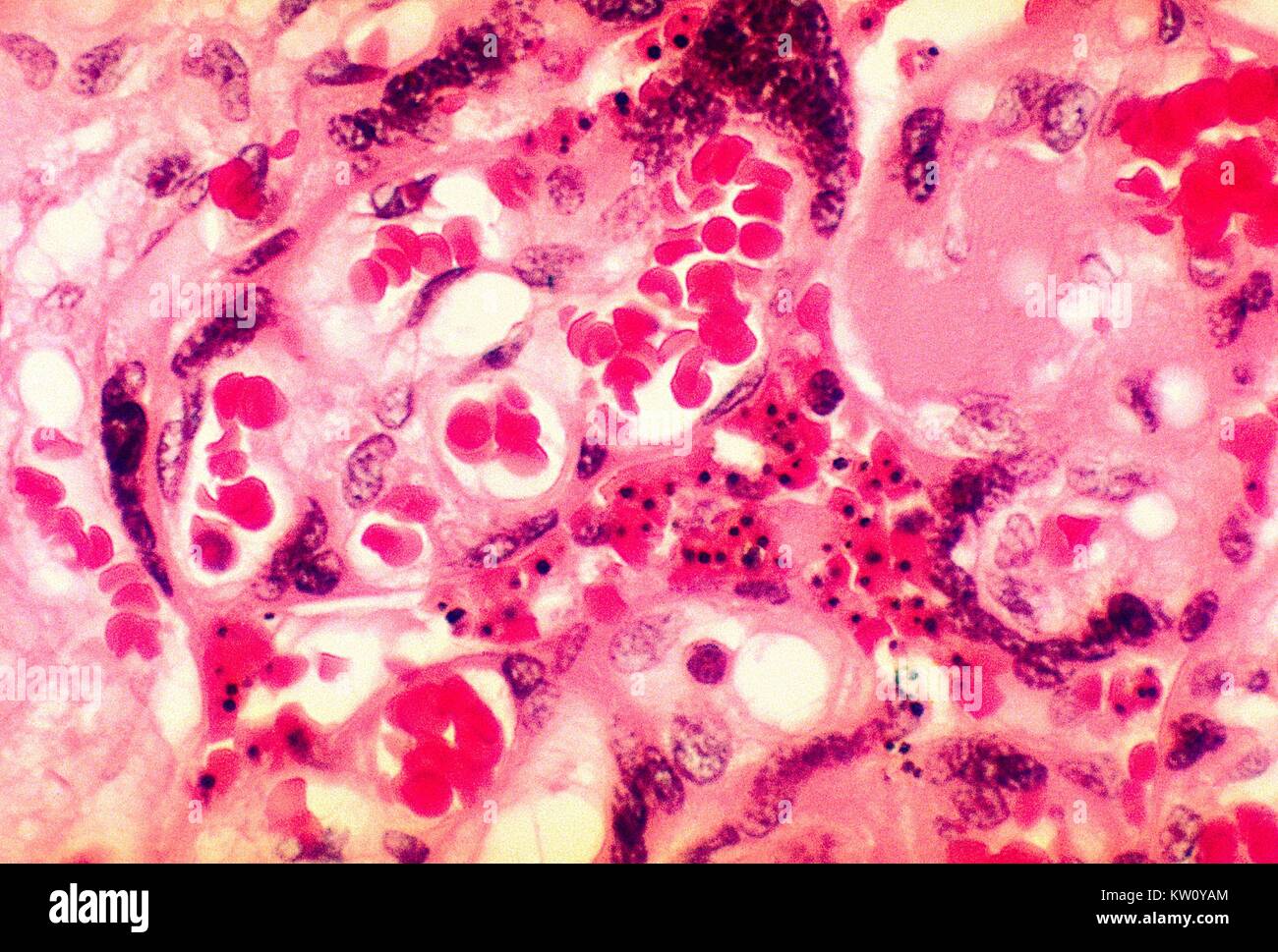A photomicrograph of placental tissue revealing the presence of the ...