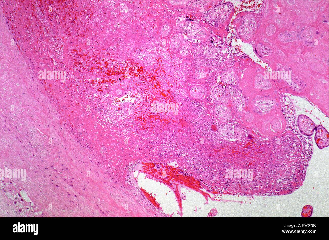 A photomicrograph describing tuberculosis of the placenta. Though a rare circumstance, Mycobacterium tuberculosis mother-to-child transmission can take place through the blood from different regions of the mother's body, or originating from lesions within the placenta as is the case here. Image courtesy CDC/Edwin P. Ewing, Jr. M.D. 1975. Stock Photo