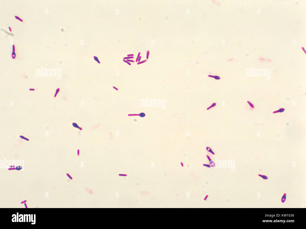 A photomicrograph of Clostridium botulinum type A viewed using a Gram stain technique. These C. botulinum bacteria were cultured in thioglycollate broth for 48 hours at 35 degrees Centigrade. The bacterium C. botulinum produces a nerve toxin, which causes the rare, but serious paralytic illness Botulism. Image courtesy CDC/Dr. George Lombard, 1978. Stock Photo