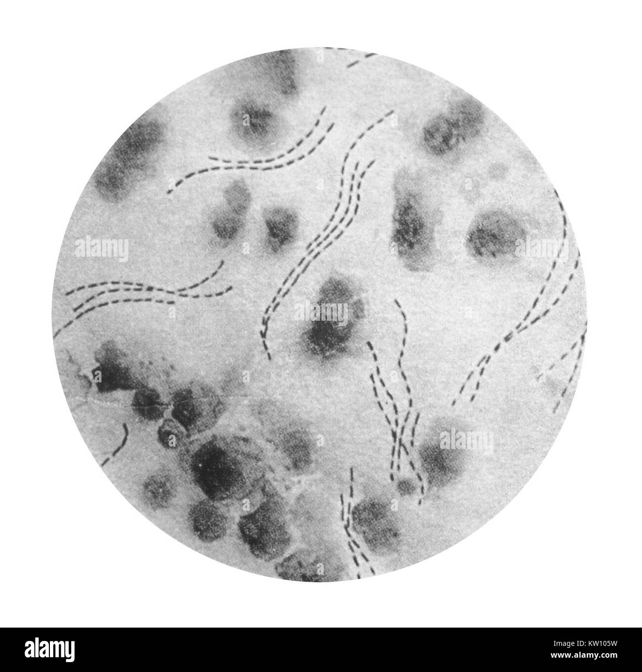 This illustration depicts a photomicrographic view of Haemophilus ducreyi bacteria stained using gentian violet. H. ducreyi causes chancroid, a highly contagious sexually transmitted disease that begins with the formation of painful open sores on the genitals. Image courtesy CDC, 1979. Stock Photo