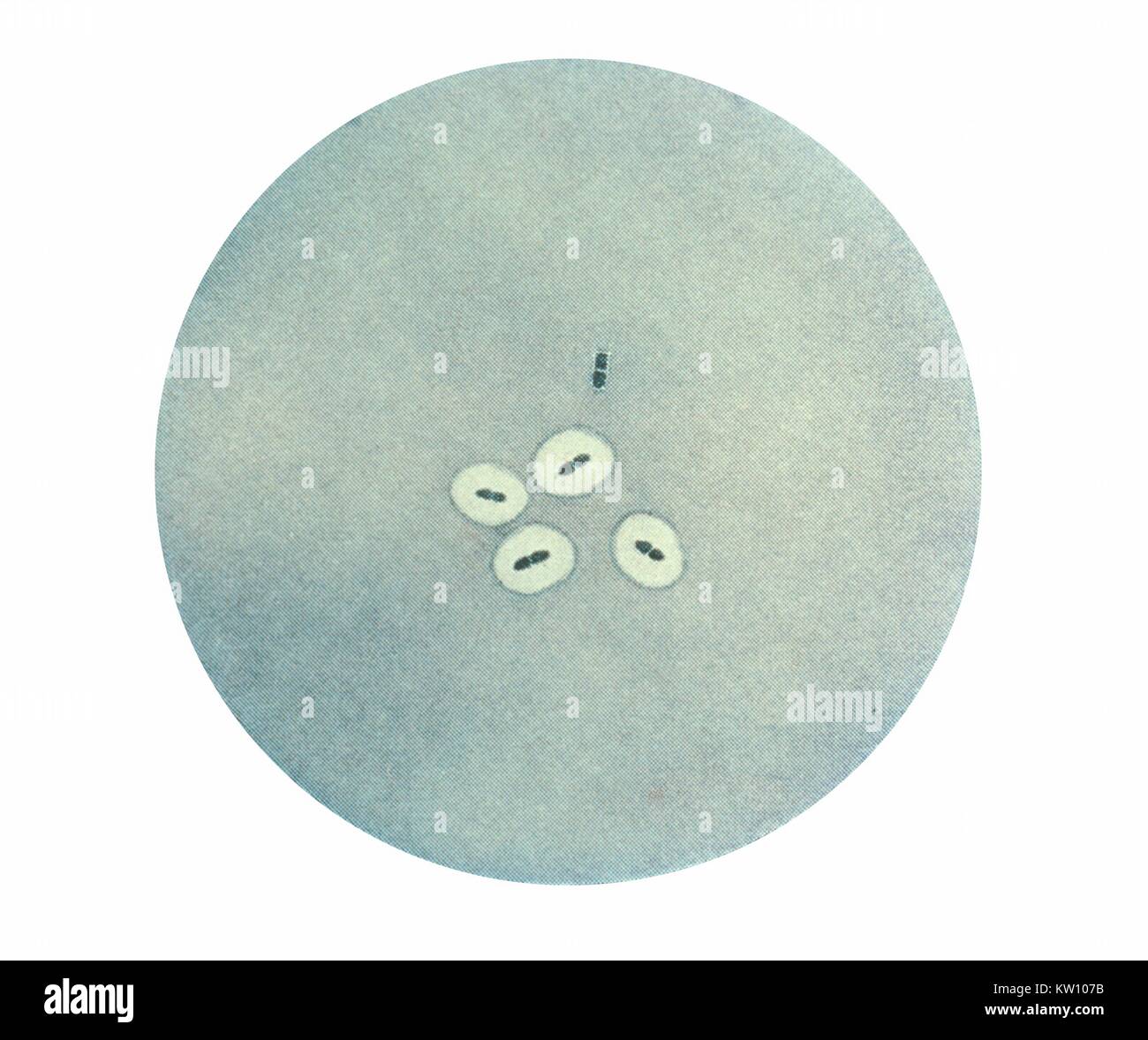 Photomicrograph of Streptococcus pneumoniae bacteria revealing capsular swelling using the Neufeld-Quellung test. This organism causes respiratory infections such as pneumonia and sinusitis, as well as bacteremia, otitis media, meningitis, peritonitis and arthritis. The Neufeld-Quellung test is used in pneumococcus typing. Streptococci. Image courtesy CDC, 1979. Stock Photo