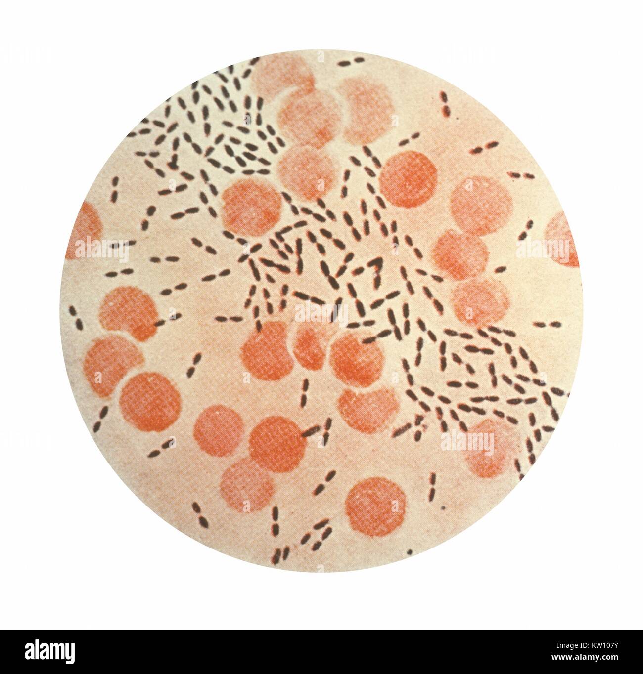 This illustration depicts a photomicrographic view of Streptococcus (Diplococcus) pneumoniae bacteria, using Gram-stain technique. Streptococcus pneumoniae is one of the most common organisms causing respiratory infections such as pneumonia and sinusitis, as well as bacteremia, otitis media, meningitis, peritonitis and arthritis. Streptococci. Image courtesy CDC, 1979. Stock Photo