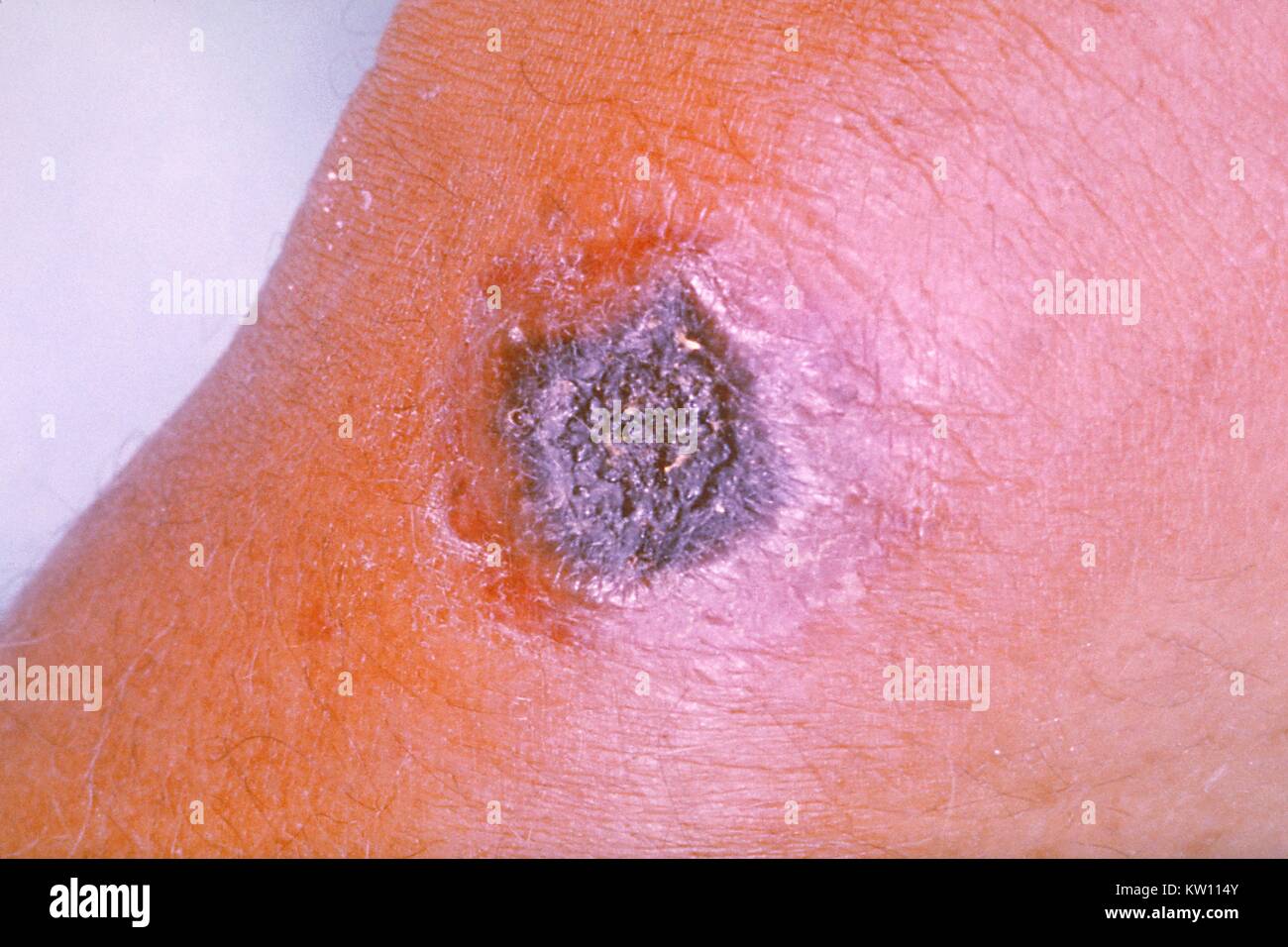 Anthrax lesion on the skin of the forearm caused by the bacterium Bacillus anthracis . Here the disease has manifested itself as a cutaneous ulceration, which has begun to turn black, hence the origin of the name 'Anthrax', after the Greek name for coal. Image courtesy CDC/James H. Steele, 1962. Stock Photo