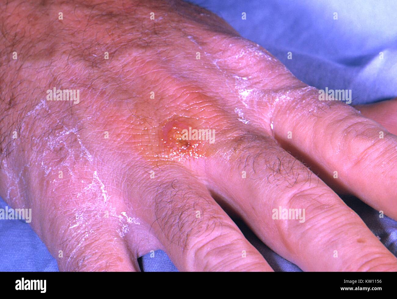 A Tularemia lesion on the dorsal skin of the right hand, caused by the bacterium Francisella tularensis . Tularemia is caused by the bacterium, Francisella tularensis . Symptoms vary depending on how the person was exposed to the disease, and as is shown here, can include skin ulcers. Image courtesy CDC/Dr. Brachman, 1963. Stock Photo
