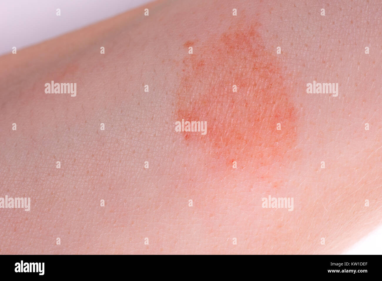 The great red spot on the skin closeup. Stock Photo