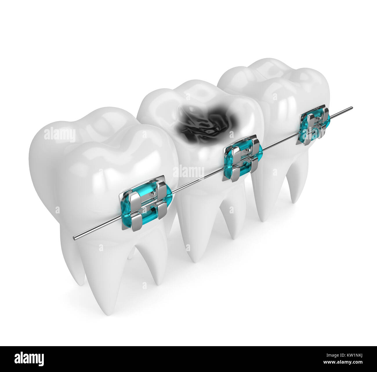 3d render of teeth with braces and caries isolated over white ...