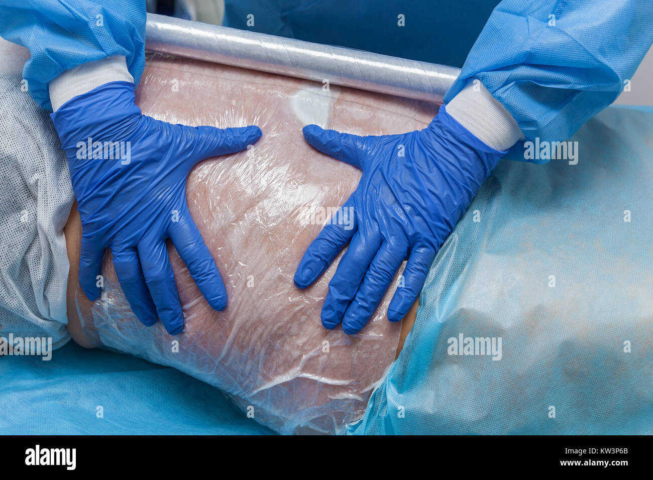 A woman undergoes the Carboxytherapy procedure on her stomach in a