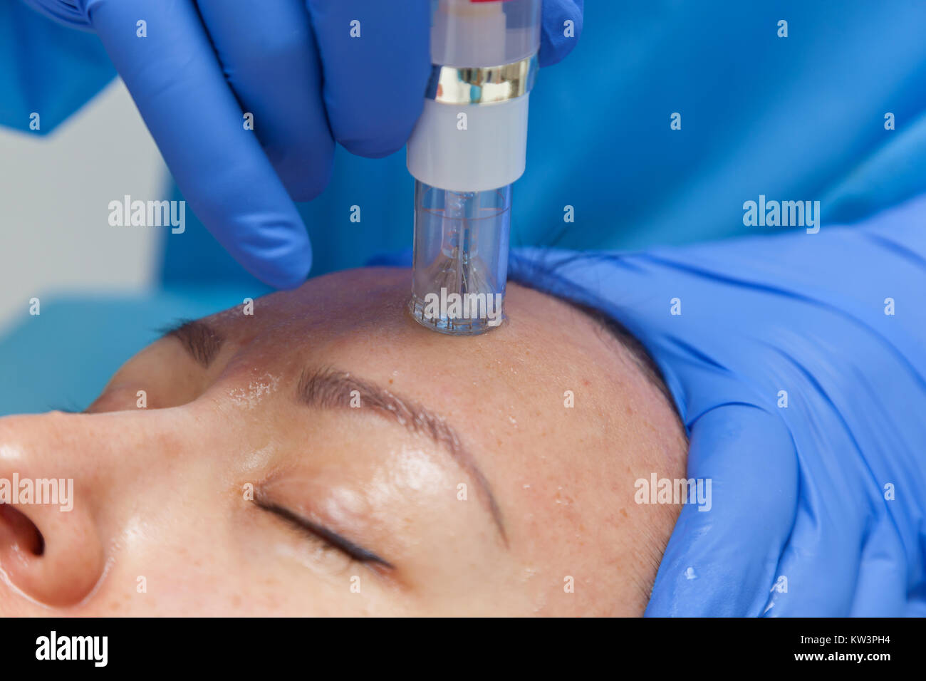 Cosmetic treatment by injection in the clinic. Use of a dermal injector