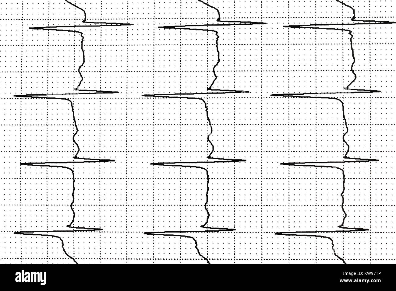 Electrocardiogram test that shows electrical activity of the heart