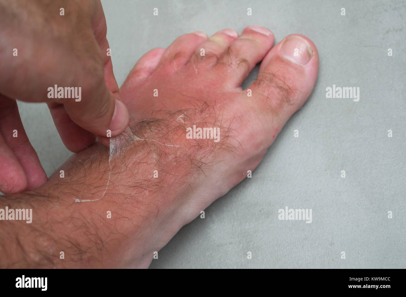 Sunburn feet hires stock photography and images Alamy