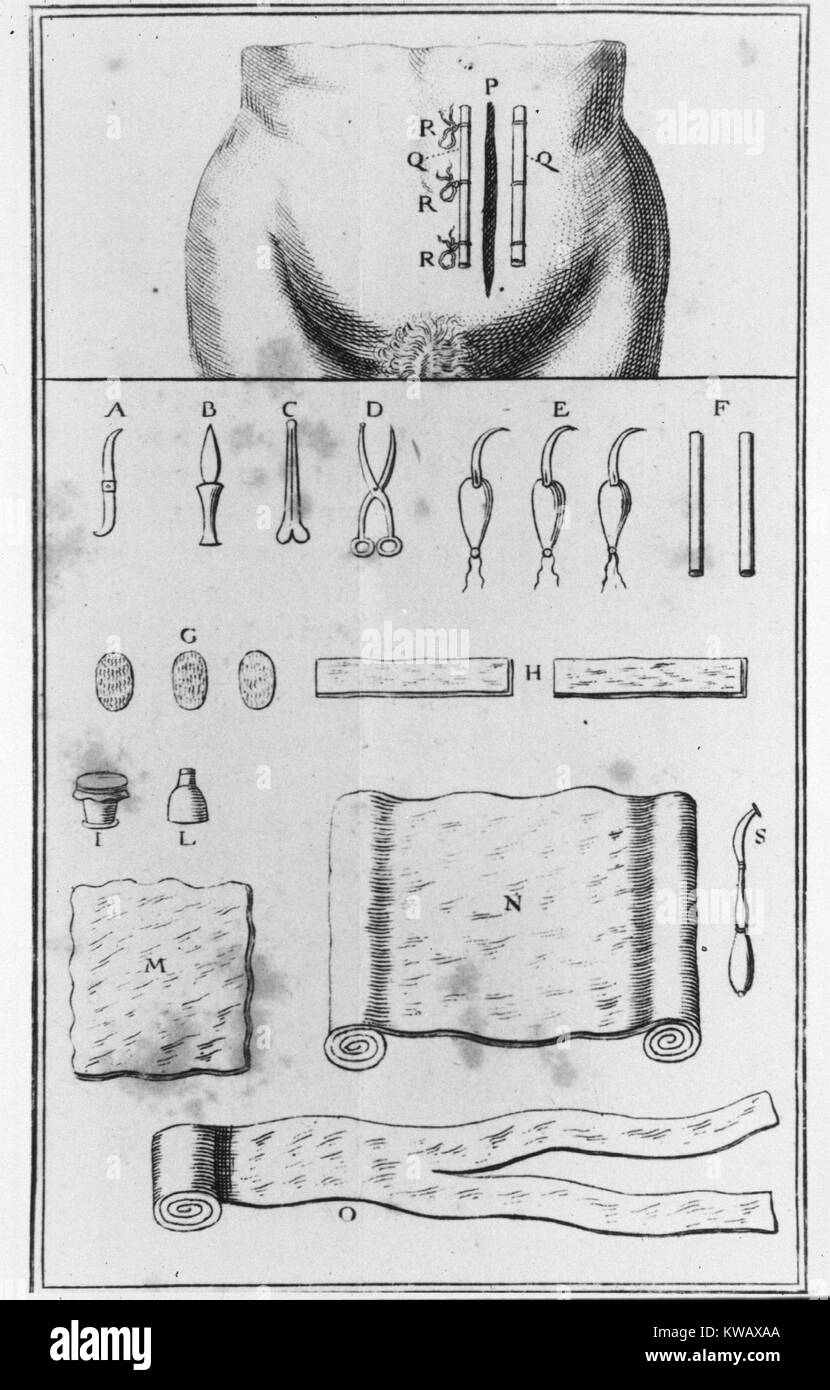 Book illustration of surgical instruments used in the incision of an abdomen, 1753. Courtesy National Library of Medicine. Stock Photo