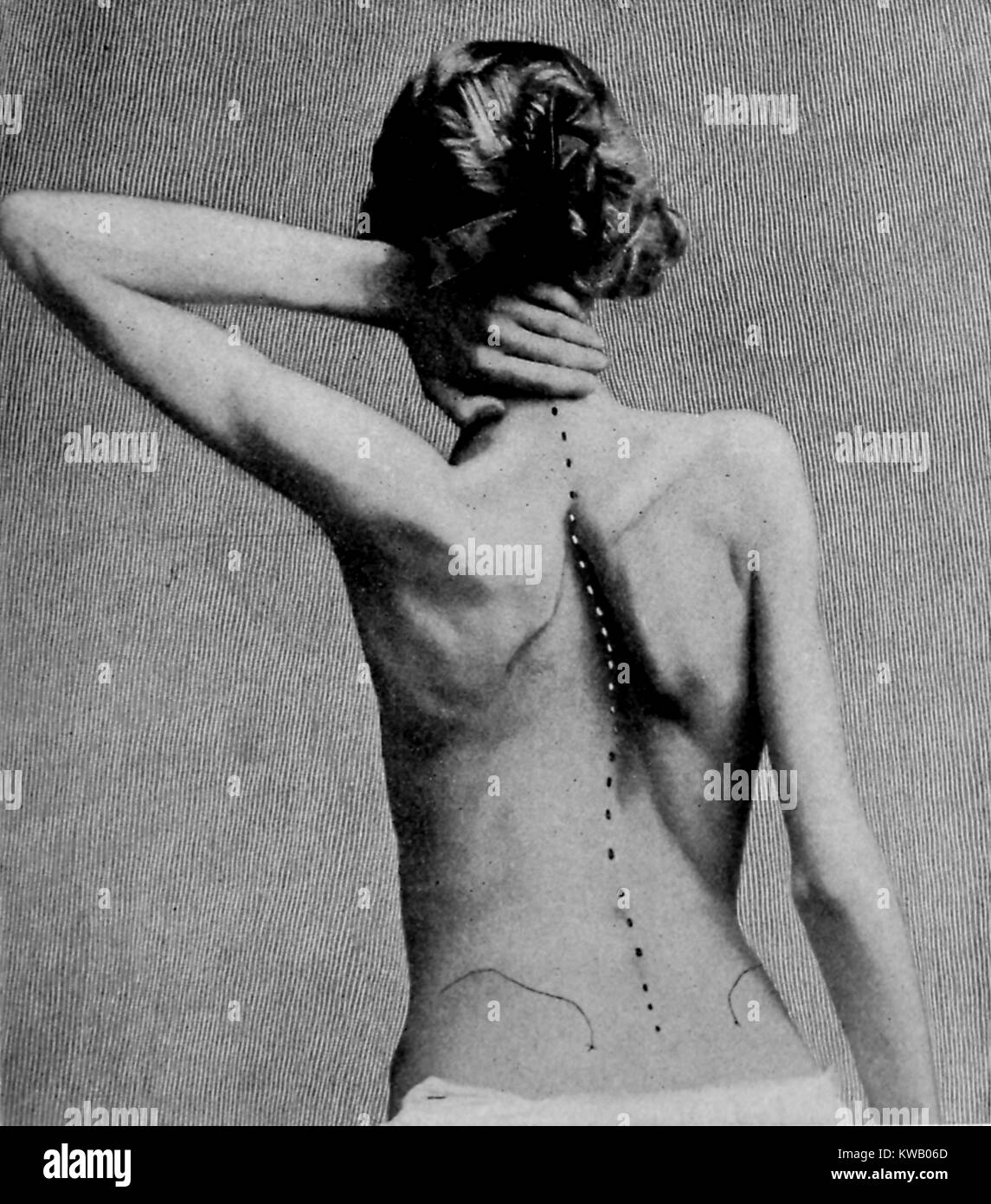 Medical illustration depicting curvature of the spine, with a female patient viewed from behind and a line on the back of the patient showing the spine's curved path, 1903. Courtesy Internet Archive. Stock Photo