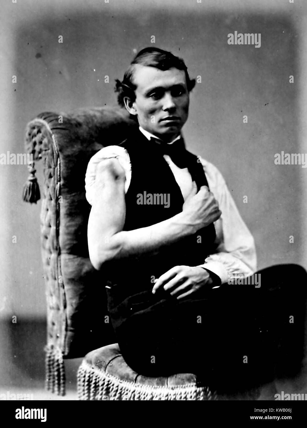 Photograph of a wounded soldier from the American Civil War, showing an upper arm wound which was repaired surgically, Virginia, 1865. Courtesy Internet Archive. Stock Photo