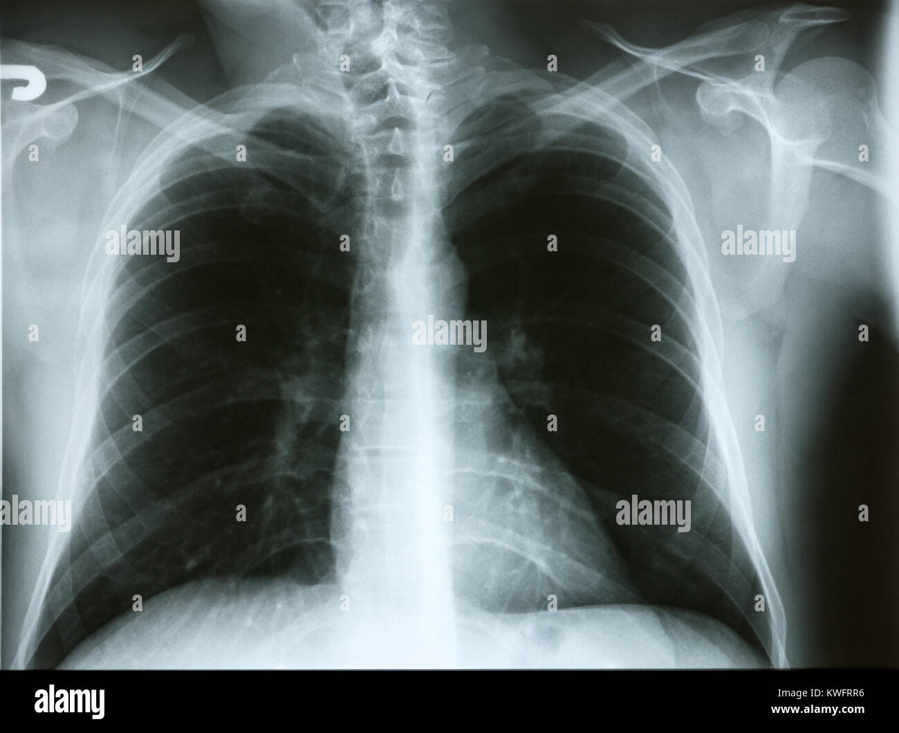 XRay Image Of Human Chest for Medical Examination of Lung Stock Photo