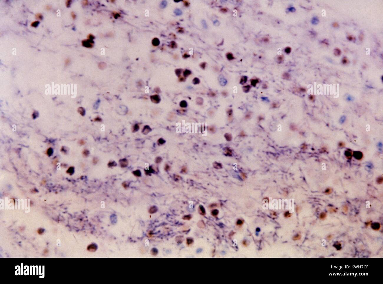This micrograph reveals a meningeal infection due to Bacillus anthracis bacteria using an HandE stain, 1966. Anthrax infections can occur in three forms: cutaneous (skin), inhalation, and gastrointestinal. Humans can become infected with anthrax by handling products from infected animals, or by inhaling anthrax spores from contaminated animal products. Image courtesy CDC/Sidney J. Benesky. Stock Photo