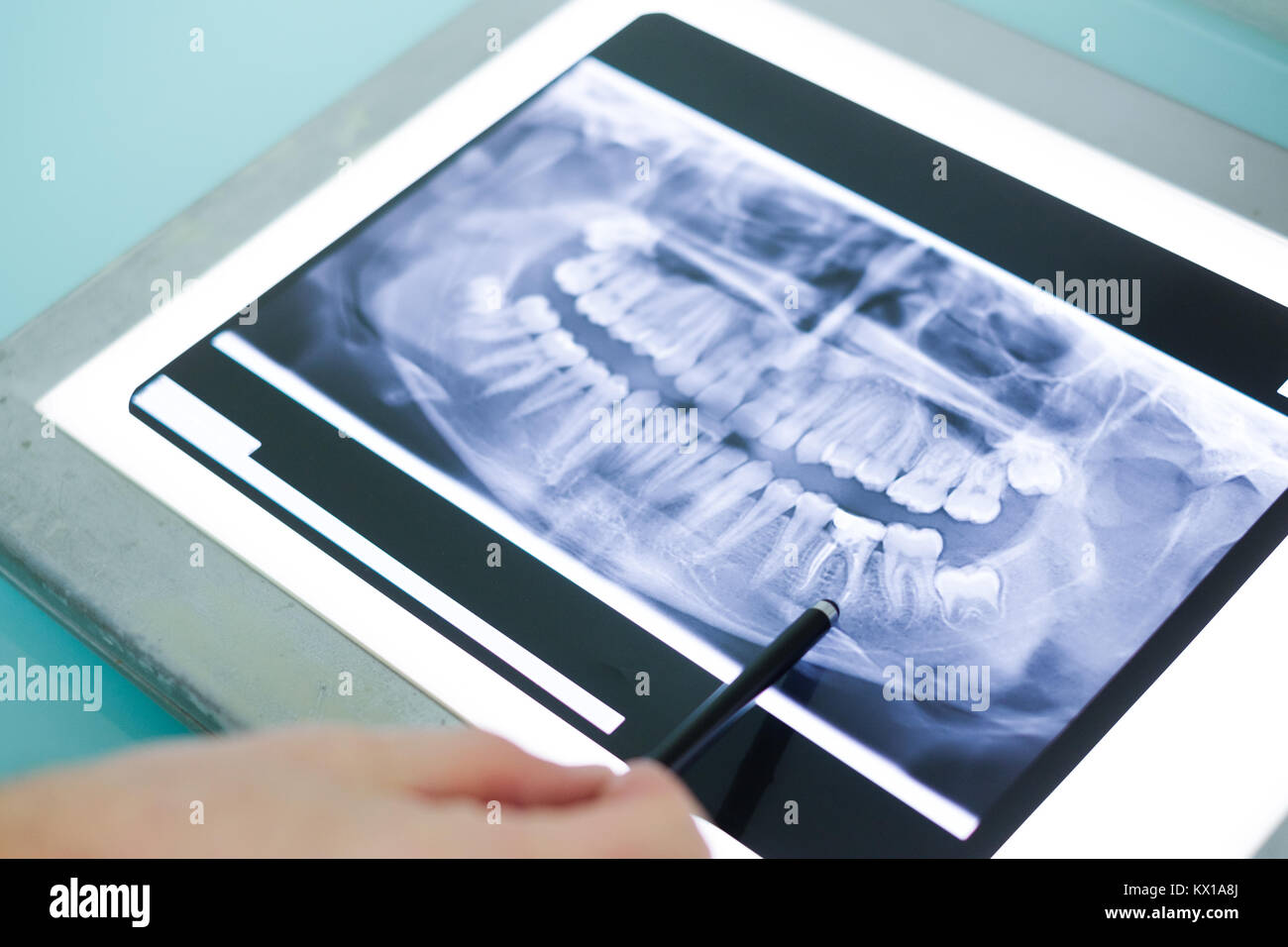 Dentist shows teeth in a xray picture Stock Photo Alamy