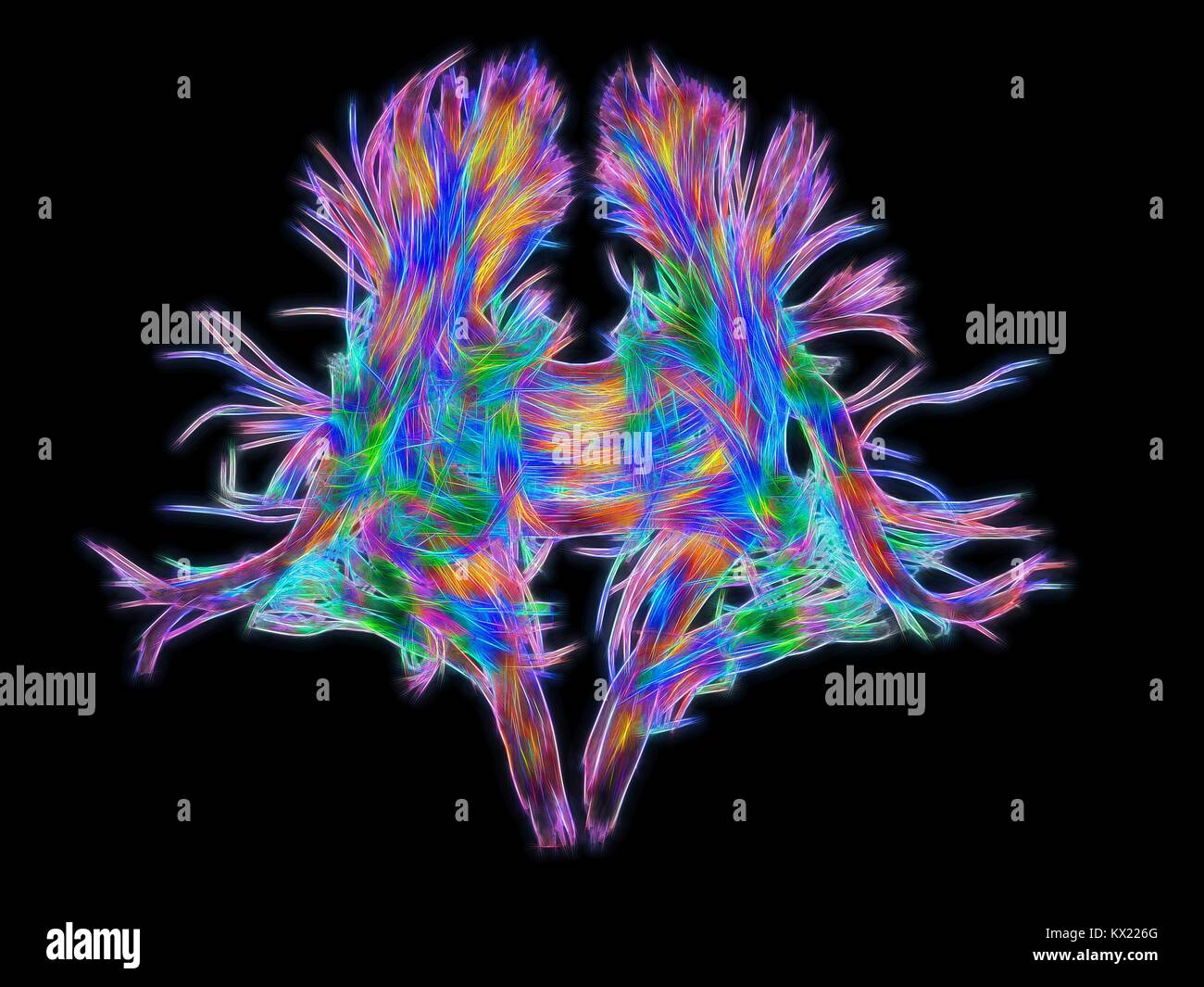 White matter fibres. Computer enhanced 3D diffusion spectral imaging (DSI) scan of the bundles of white matter nerve fibres in the brain. The fibres transmit nerve signals between brain regions and between the brain and the spinal cord. Diffusion spectrum imaging (DSI) is a variant of magnetic resonance imaging (MRI) in which a magnetic field maps the water contained in neuron fibers, thus mapping their criss-crossing patterns. A similar technique called diffusion tensor imaging (DTI) is also used to explore neural data of white matter fibres in the brain. Both methods allow mapping of their Stock Photo
