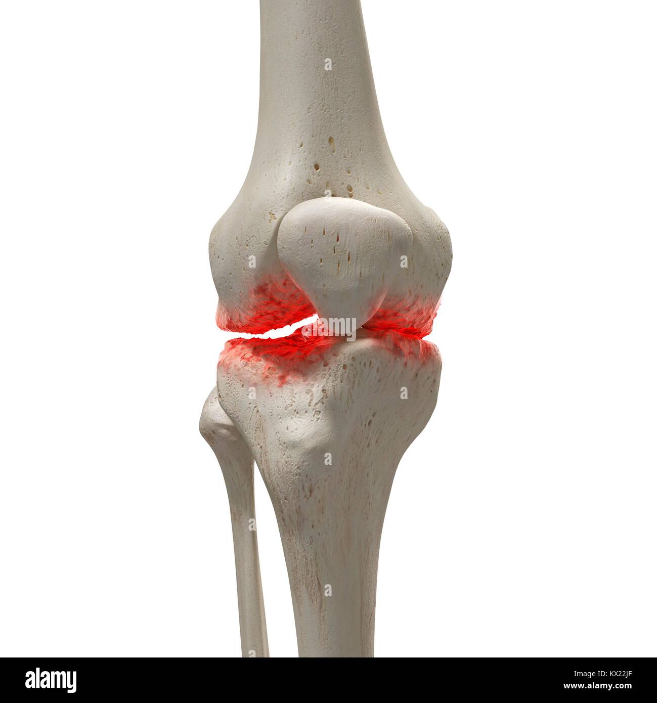 Arthritis in the knee, illustration Stock Photo Alamy