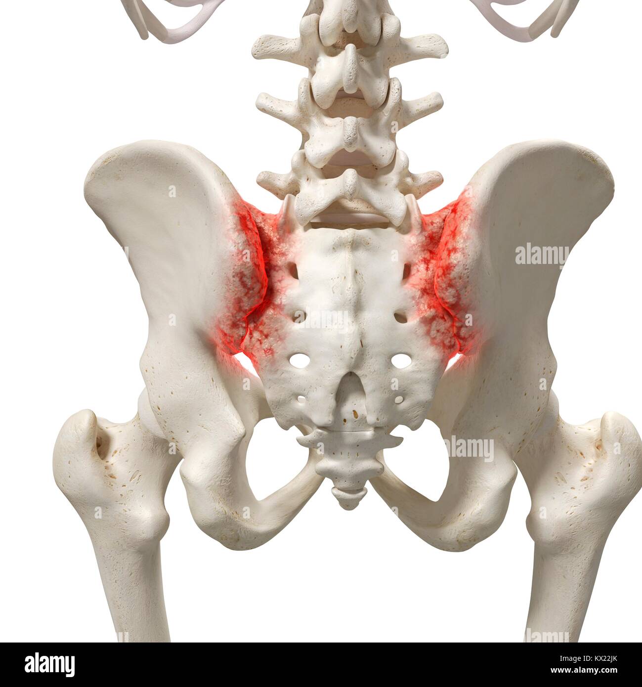 Arthritis in the sacrum, illustration. Stock Photo