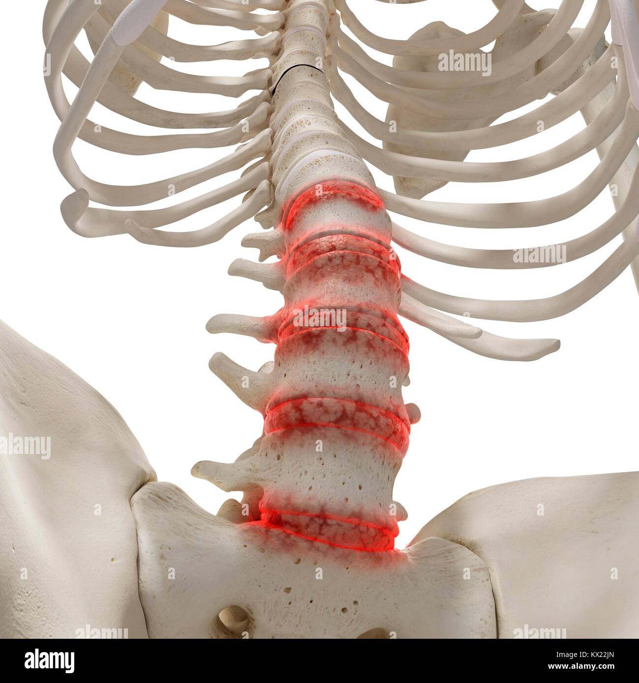 Arthritis in the lumbar spine, illustration Stock Photo Alamy