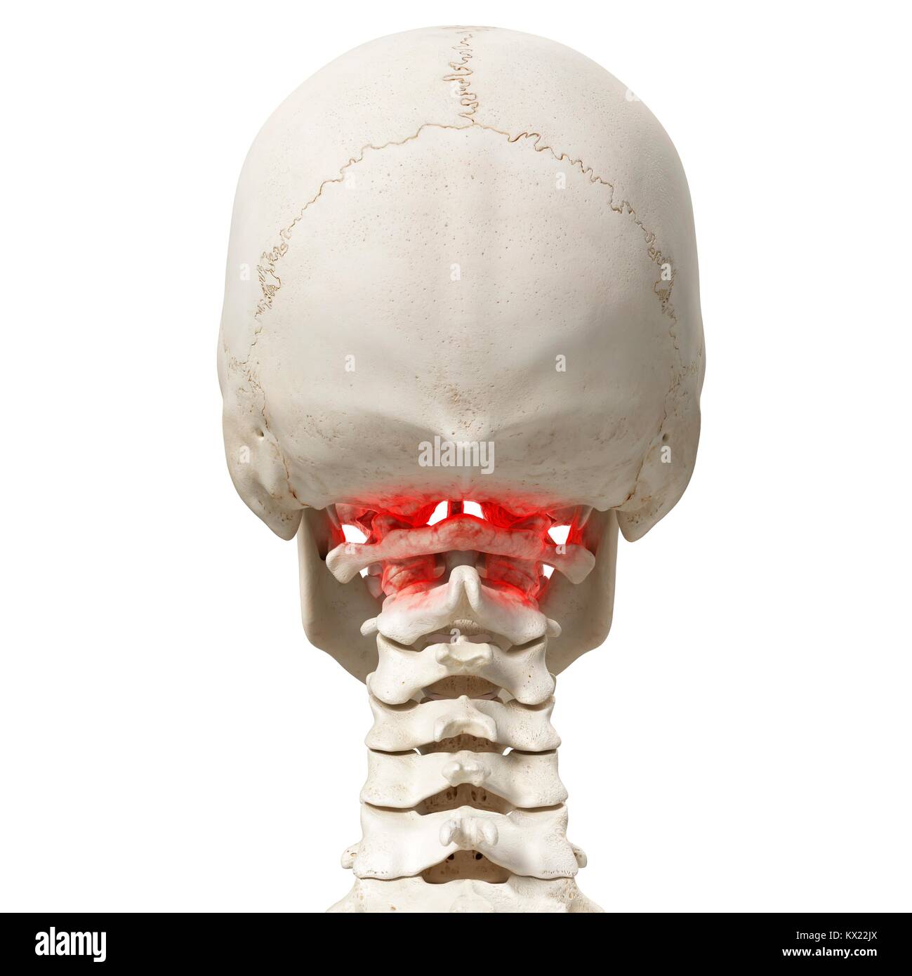 Arthritis in the cervical spine hires stock photography and images Alamy