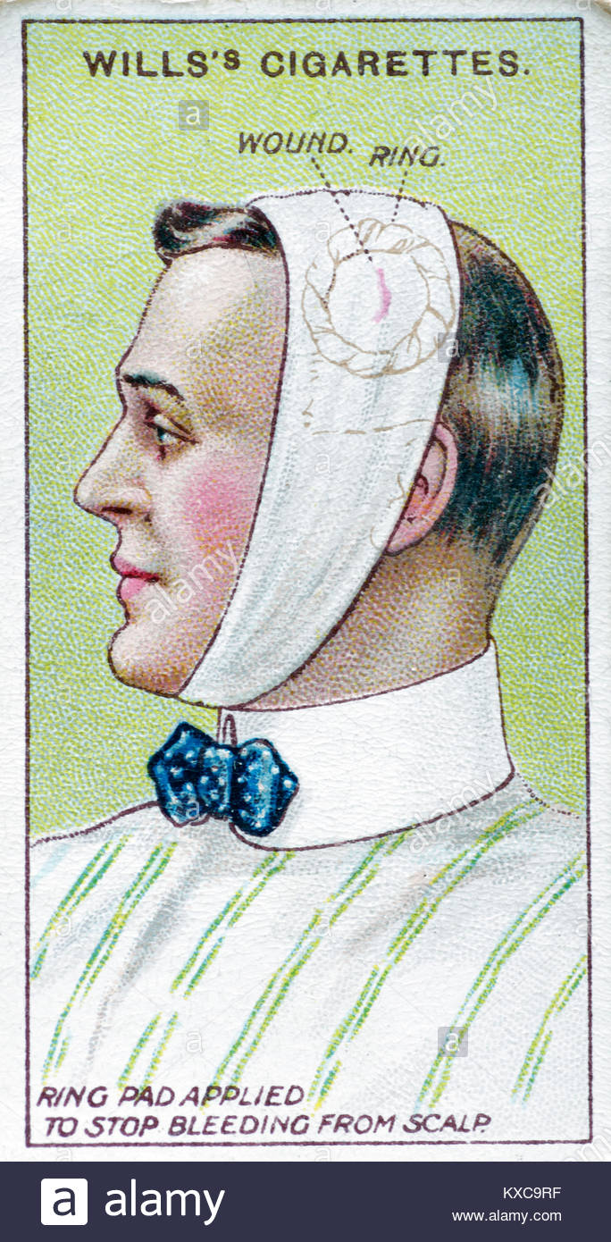 Vintage First Aid illustrations Ring pad applied to stop bleeding from scalp Stock Photo Alamy