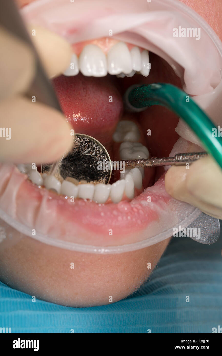 Ejector saliva hires stock photography and images Alamy