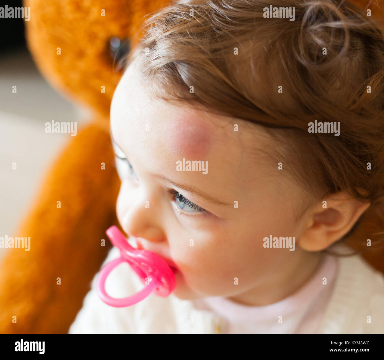 Toddler with big bruise on his forehead after bumping. Children often accidentally bump their heads. Stock Photo