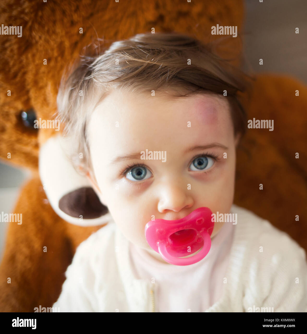 Toddler with big bruise on his forehead after bumping. Children often accidentally bump their heads. Stock Photo