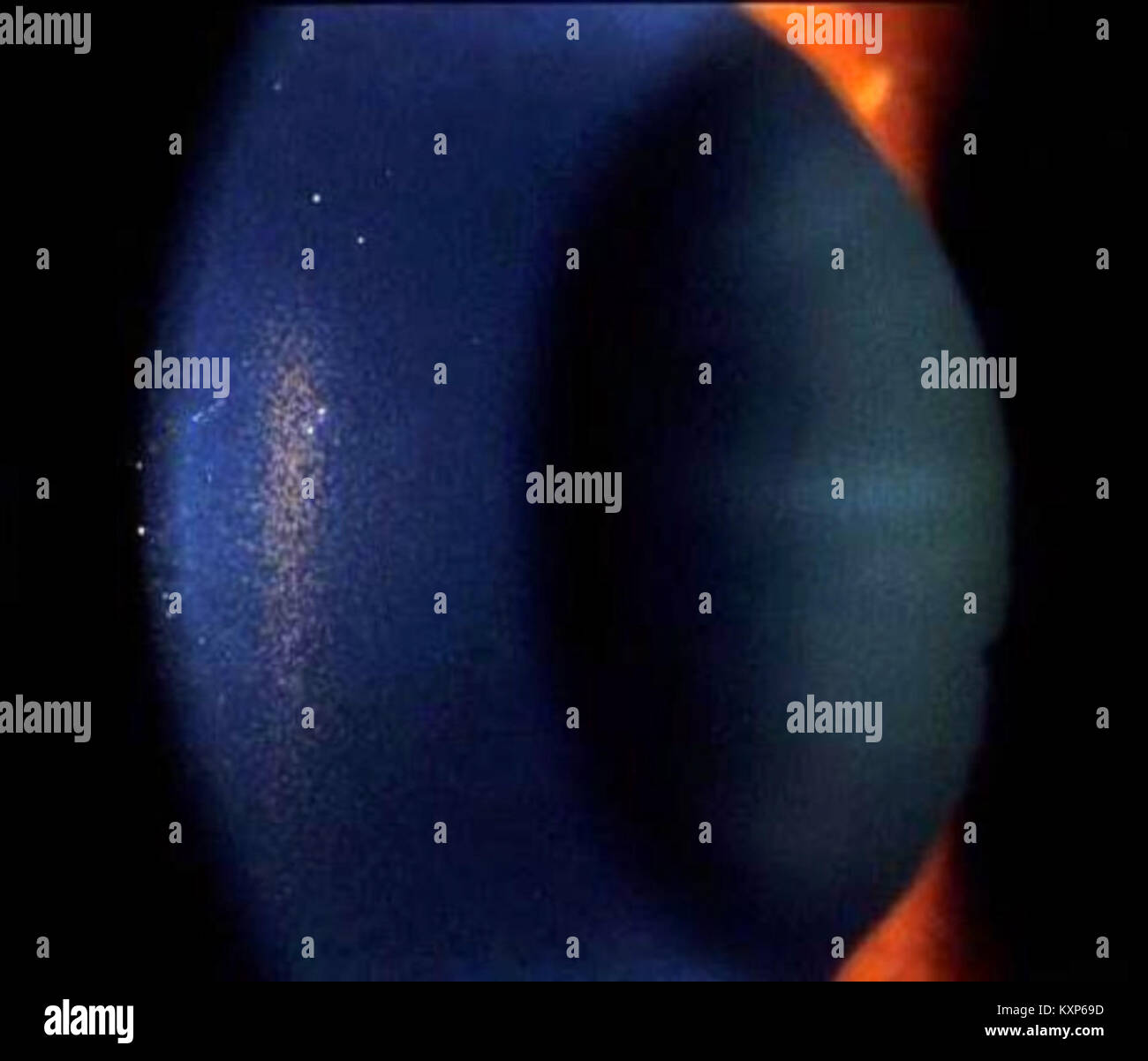 Cornea showing Krukenberg's Spindle Stock Photo Alamy